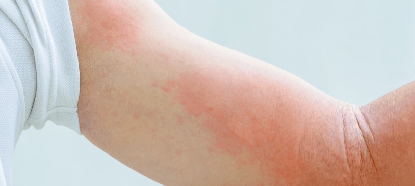 Atopisches Ekzem Und Neurodermitis La Roche Posay