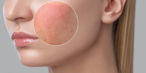 Allergische Haut erkennen und pflegen | La Roche Posay Allergische Haut erkennen und pflegen | La Roche Posay