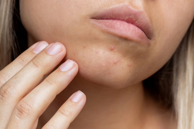 LaRochePosay-concern-sensitive-skin-perioale-Dermatitis-Header