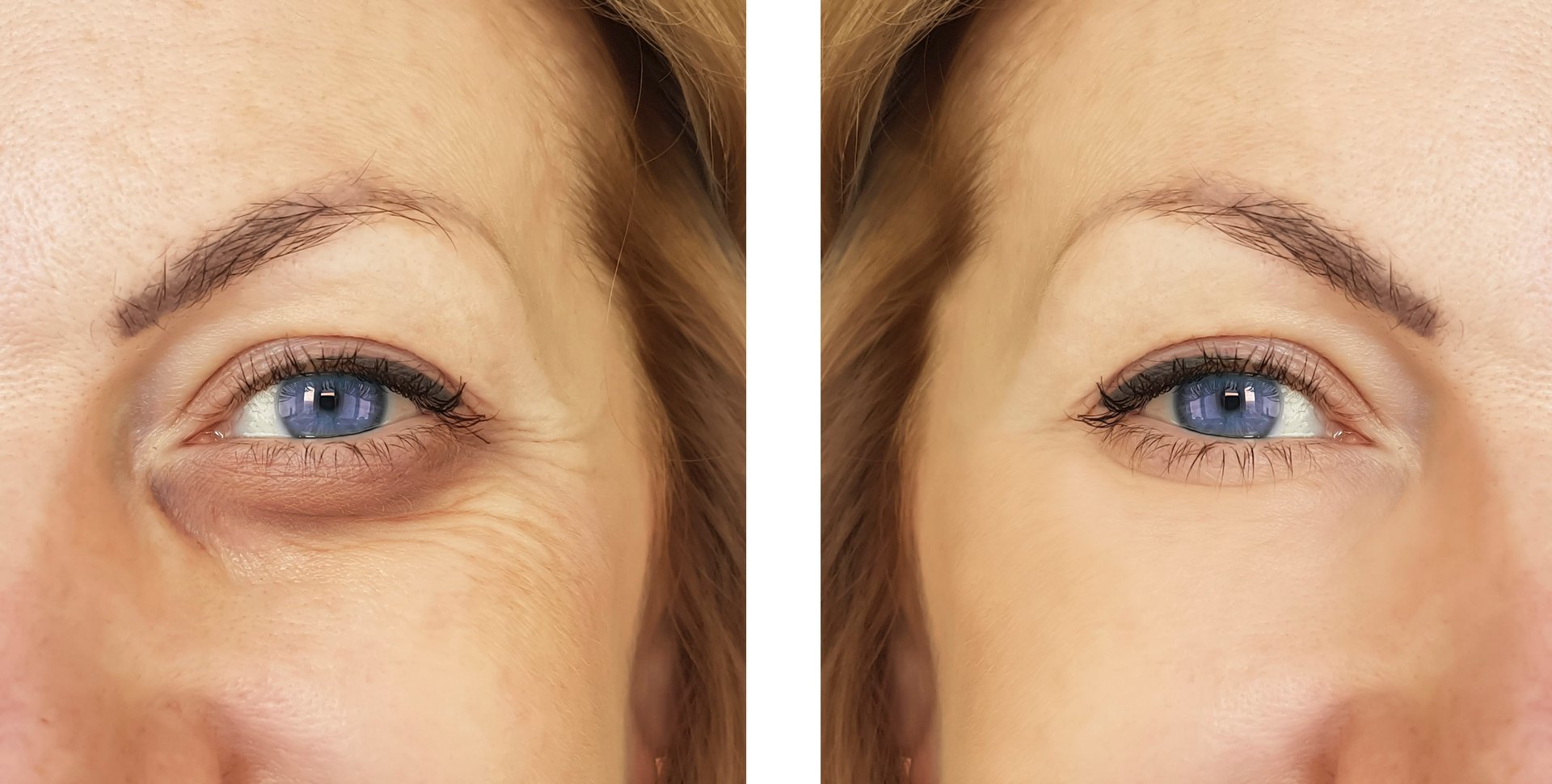 Vorher-Nachher-Vergleich: Augenpartie mit glatterer Haut