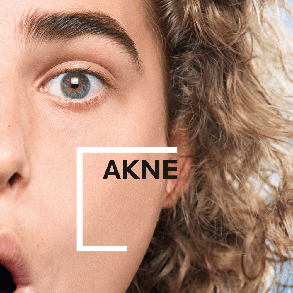 Akne