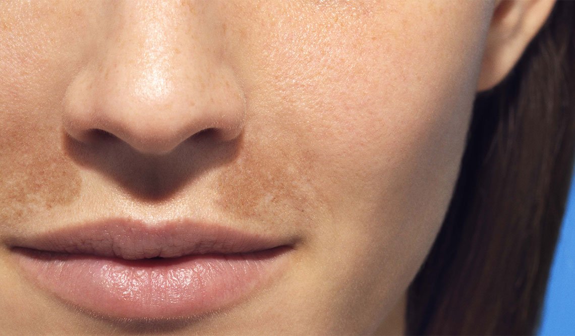 Pigmentflecken Worauf Sie Achten Sollten La Roche Posay